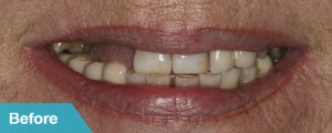 porcelain-crowns-before